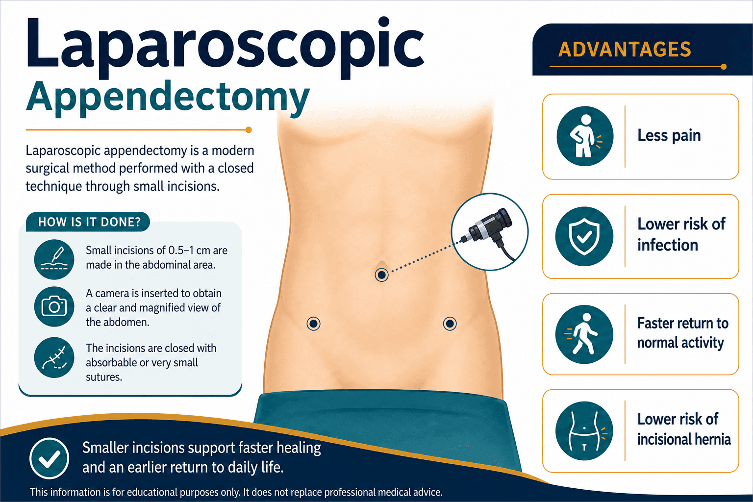 Laparoscopic appendectomy — educational figure