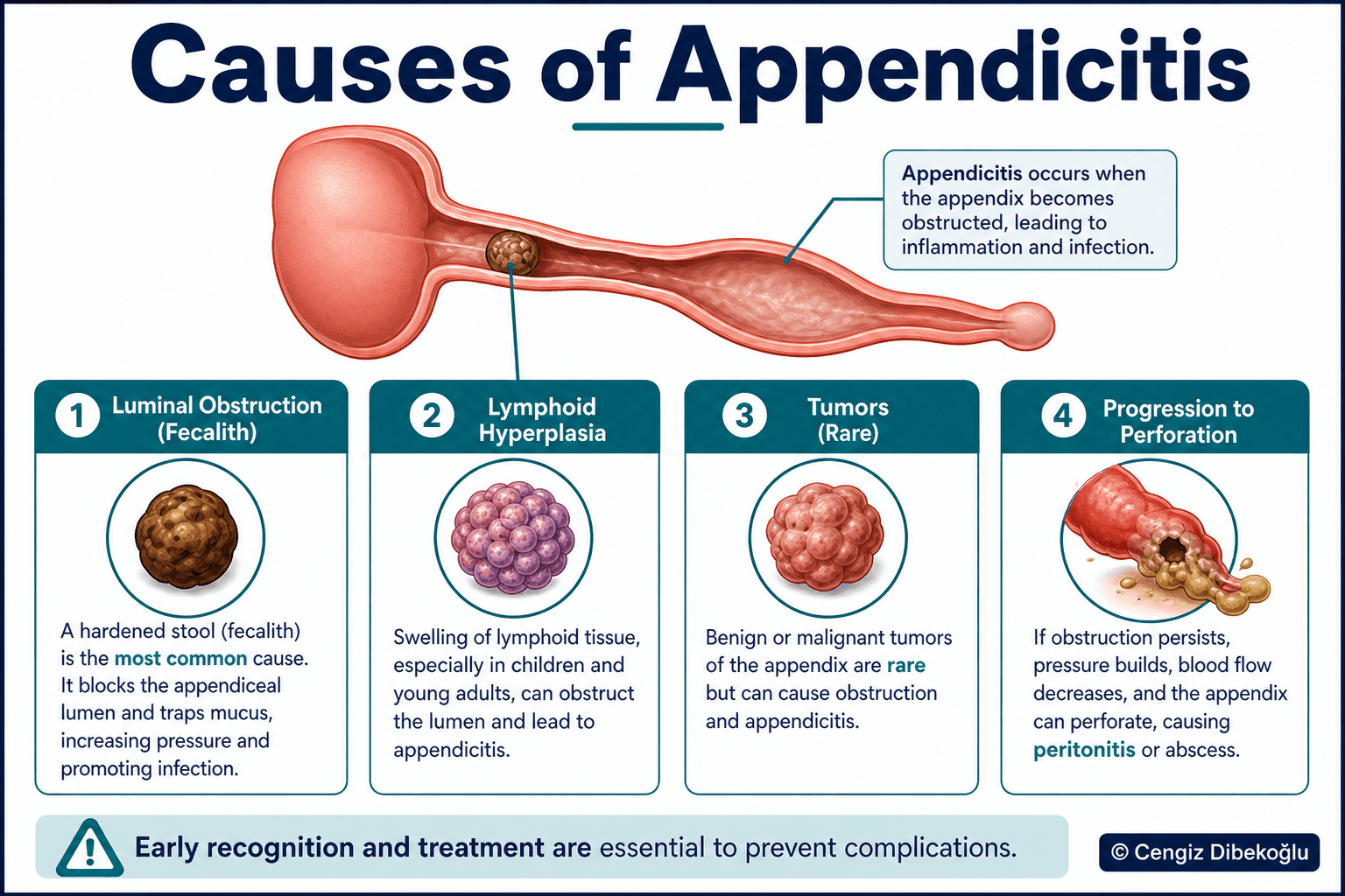 Causes of appendicitis — educational figure