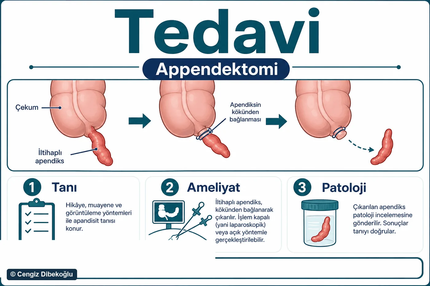 3D diagram: appendectomy
