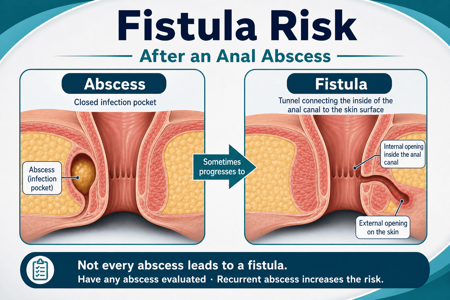 Abscess to fistula risk — educational figure