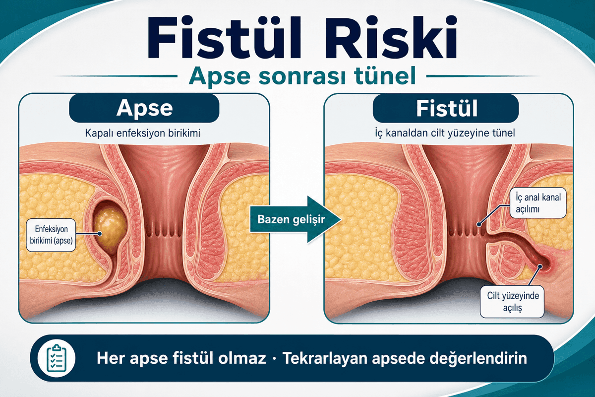Fistül riski
