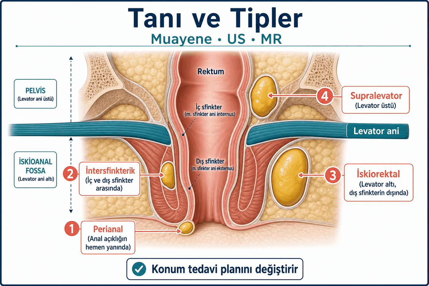 Tanı ve tipler