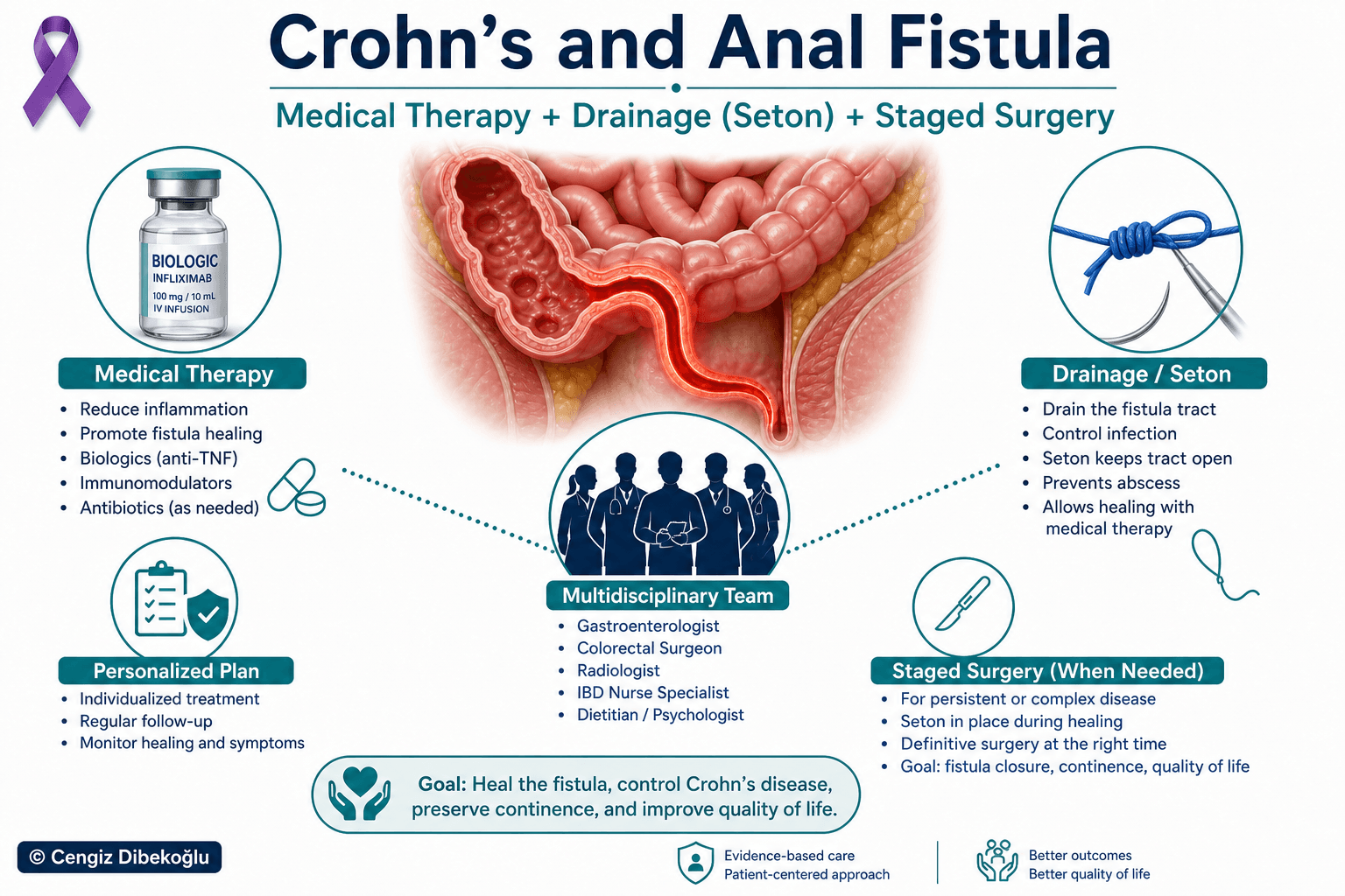 Crohn’s-related anal fistula — educational figure