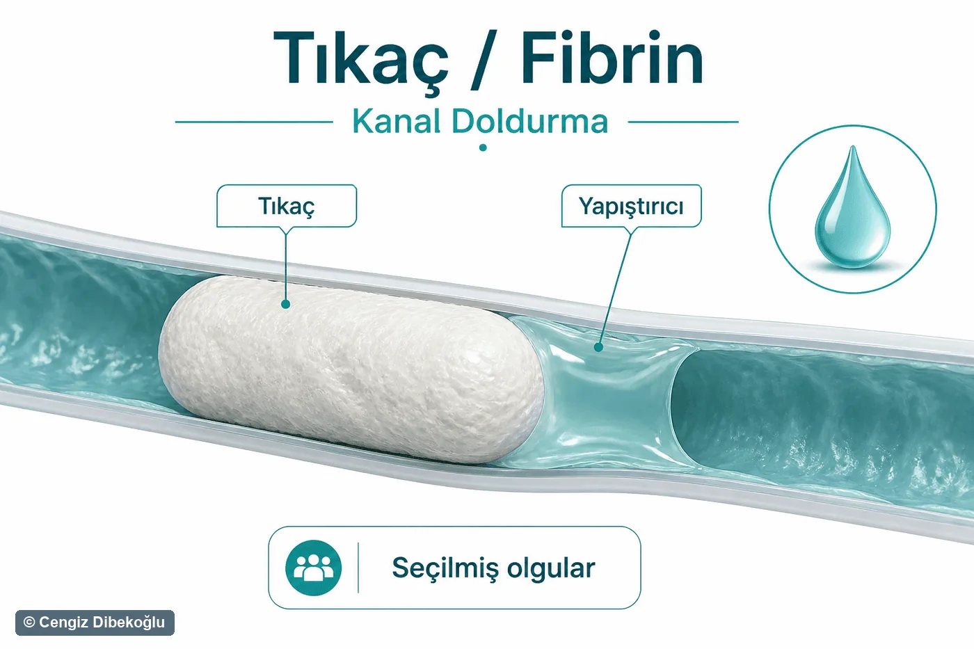 3D diagram: fistula plug