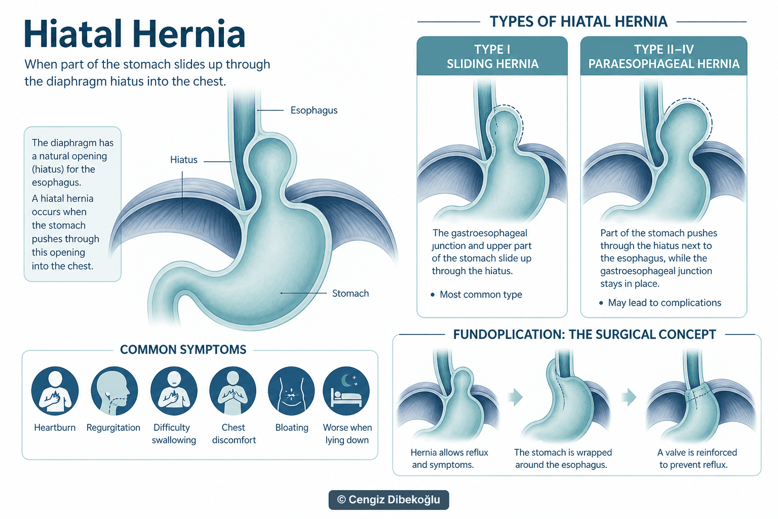 Hiatal hernia — educational figure