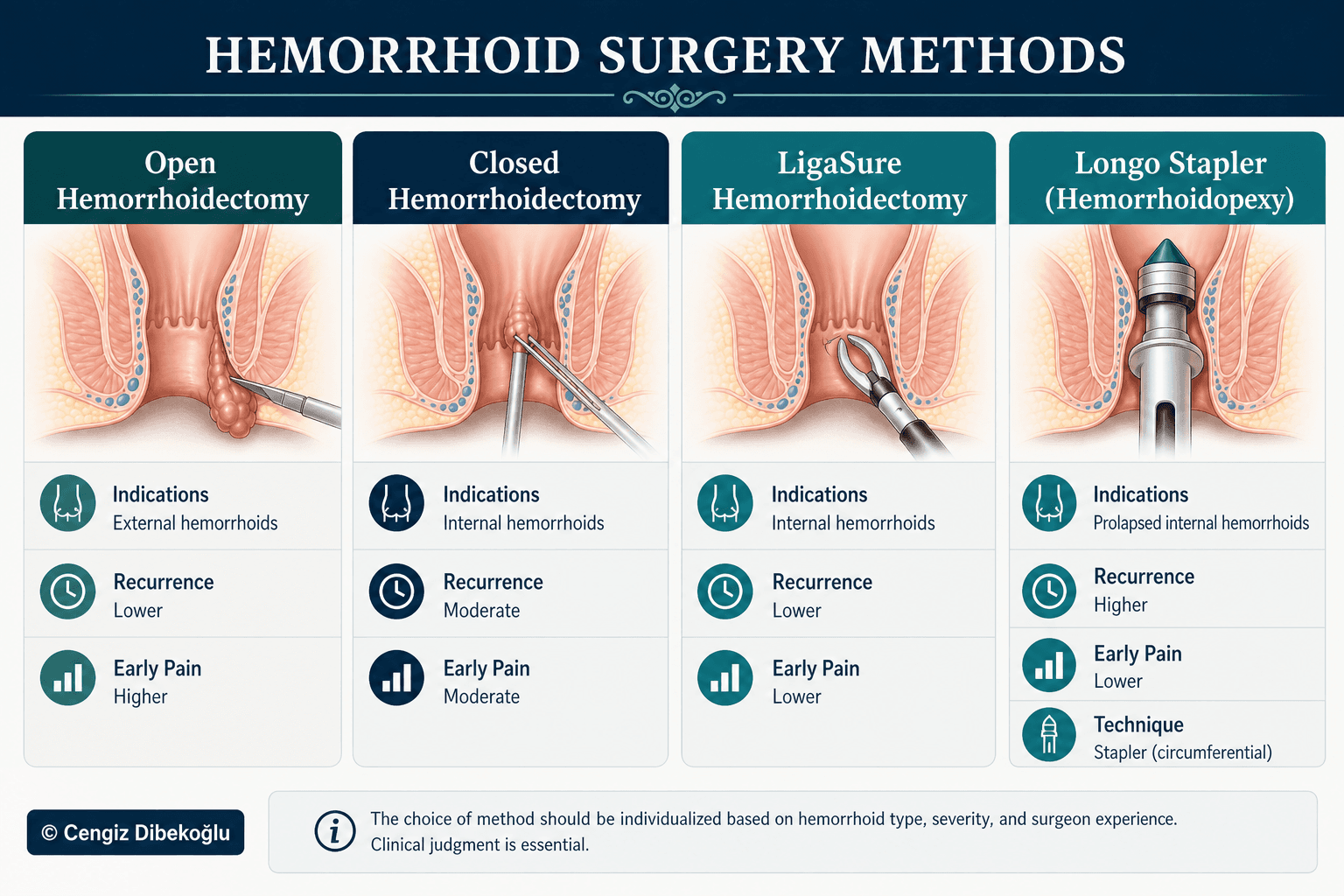 Hemorrhoid surgery methods — educational figure