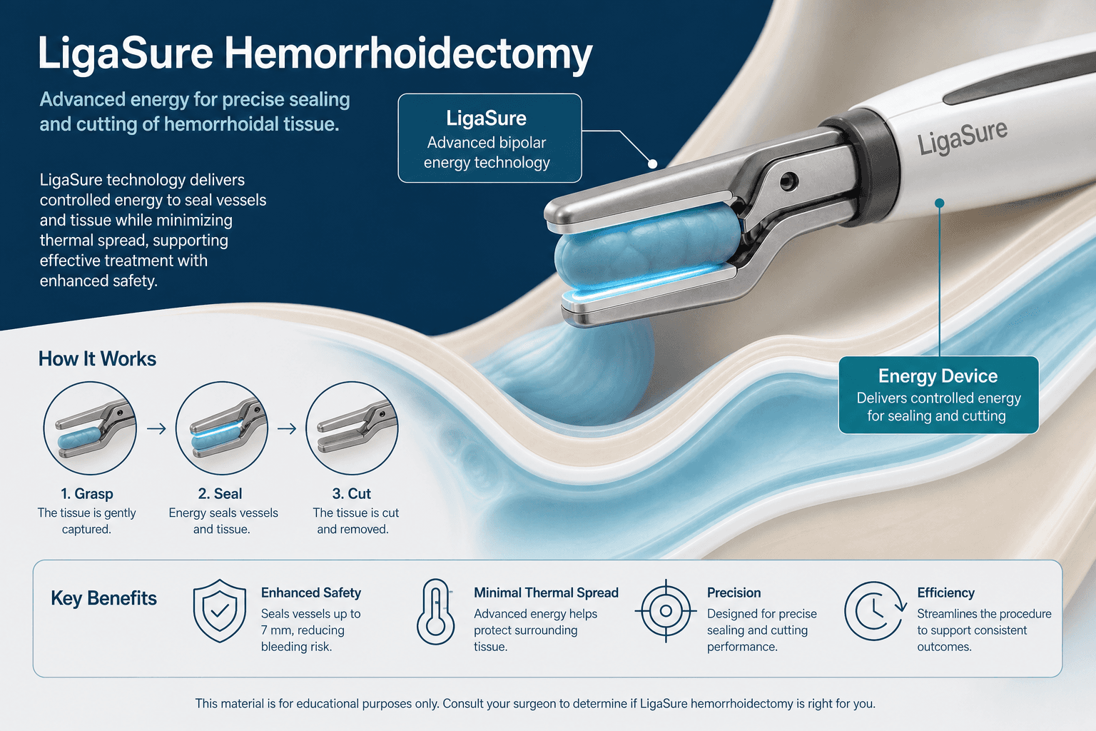 LigaSure hemorrhoidectomy — educational figure