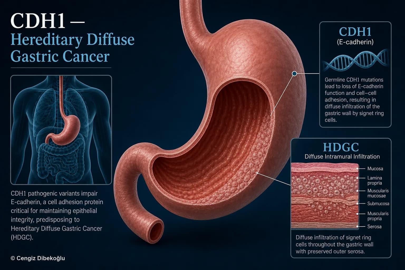 CDH1 and hereditary diffuse gastric cancer — educational figure
