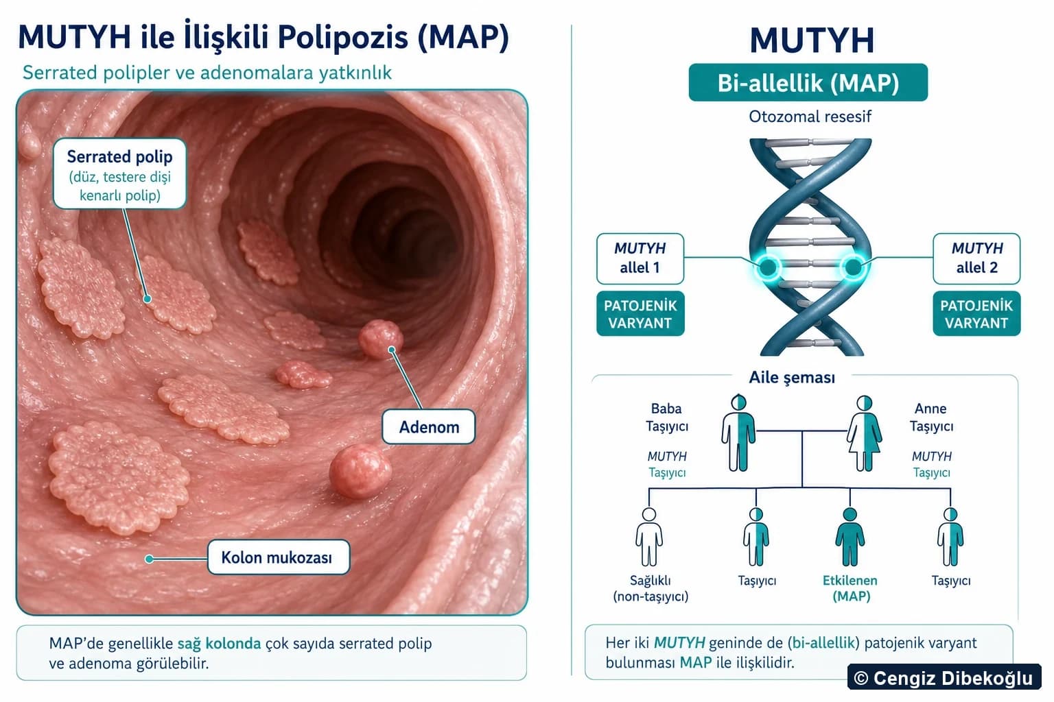 3D şema: serrated polipler ve MUTYH bi-allellik (MAP) genetiği