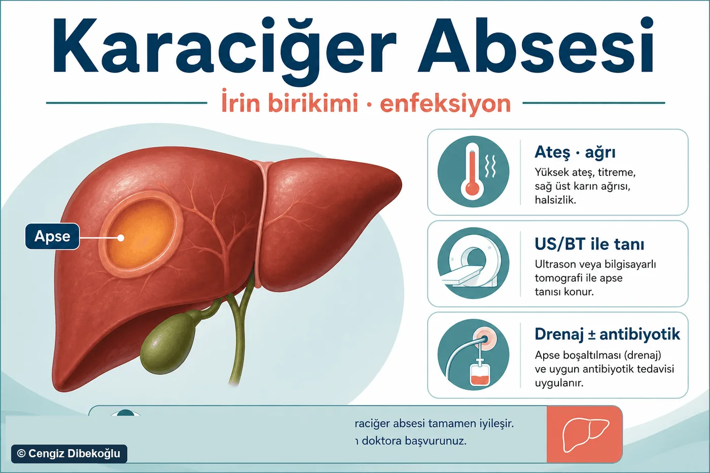 3D diagram: liver abscess