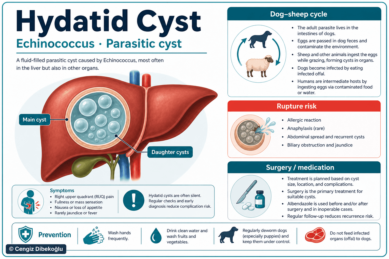Hepatic hydatid cyst — educational figure