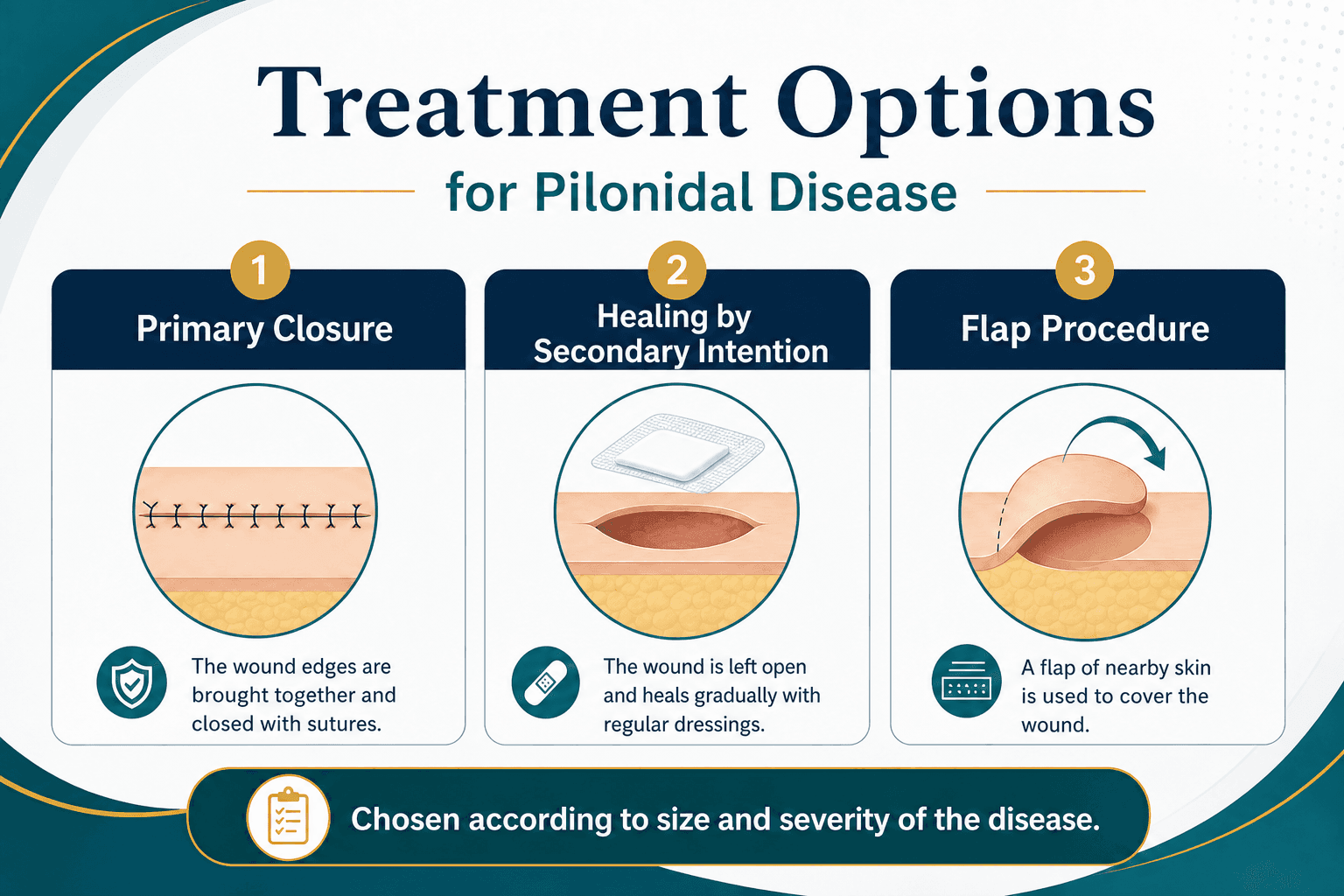 Pilonidal treatment options — educational figure