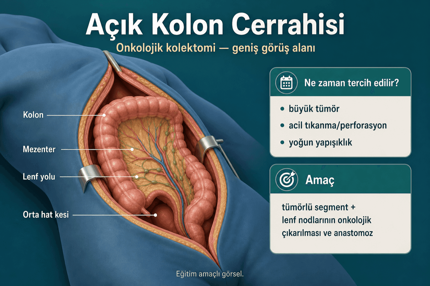 Açık kolon cerrahisi görseli