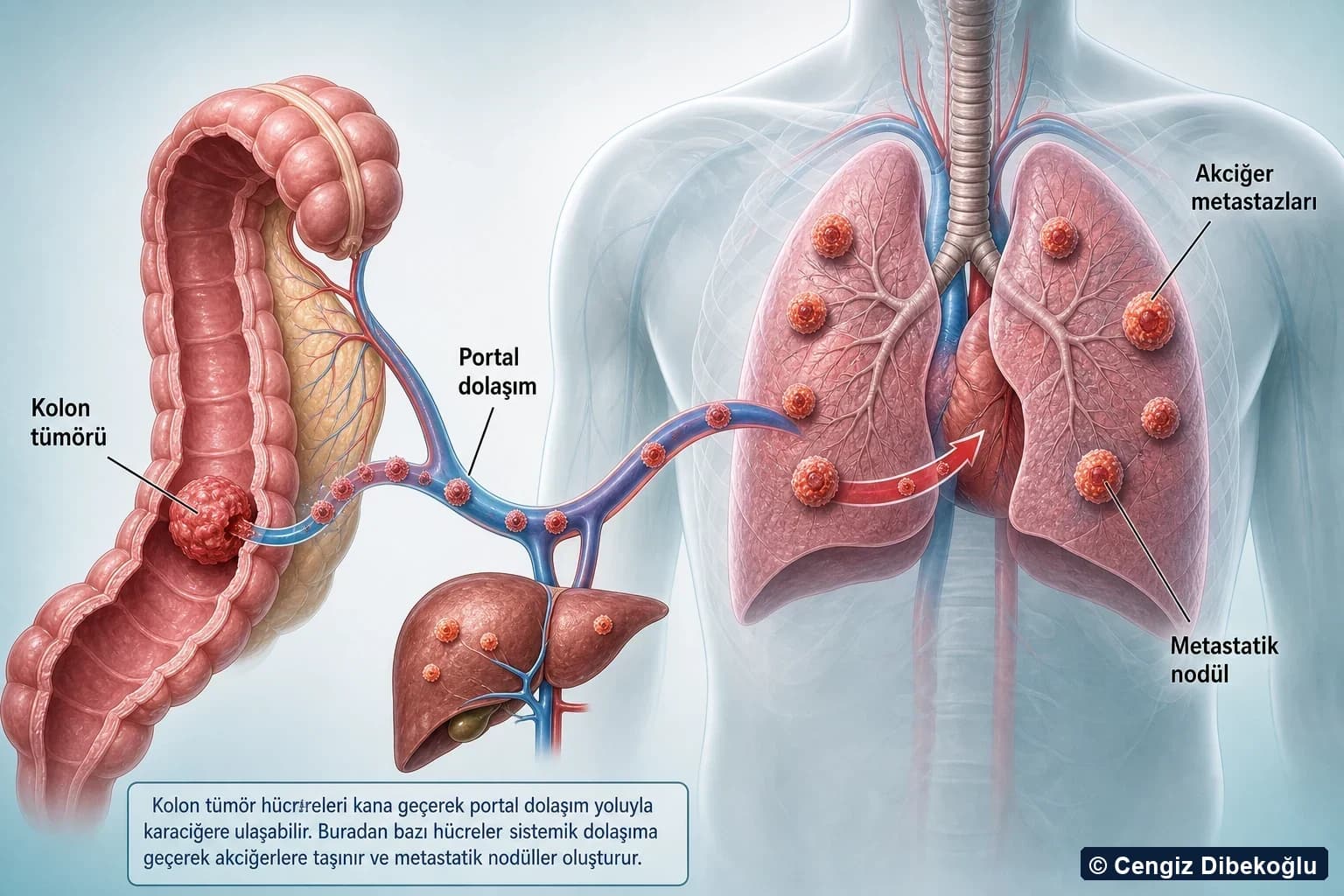 3D şema: kolon tümöründen portal dolaşım yoluyla akciğer metastazları