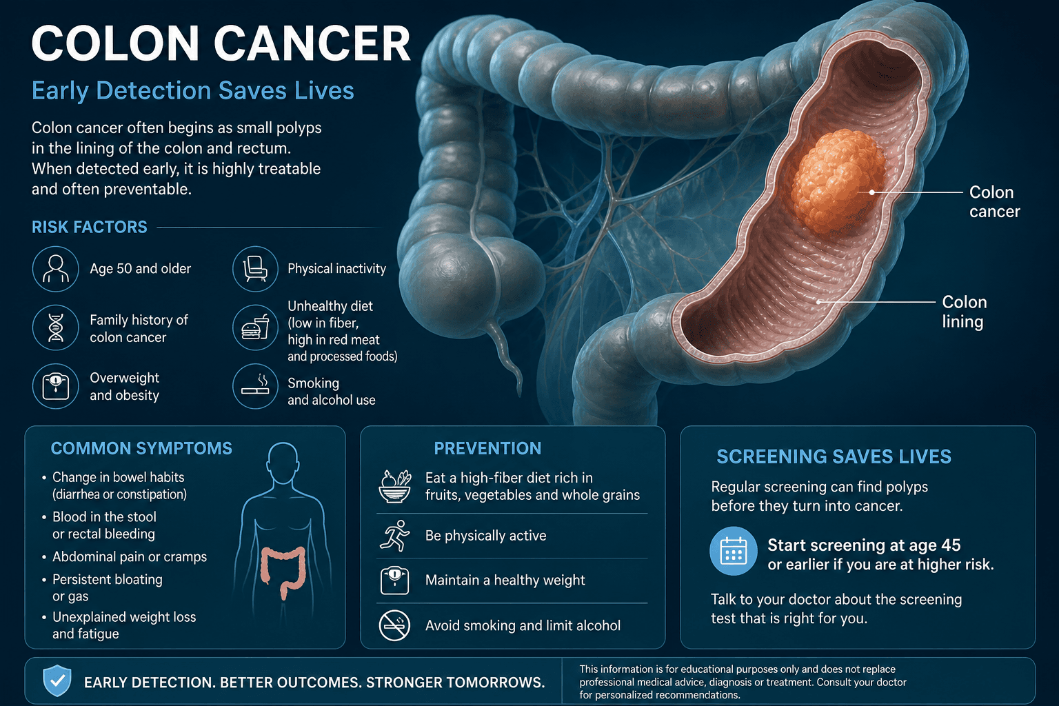 Colon Cancer — educational figure