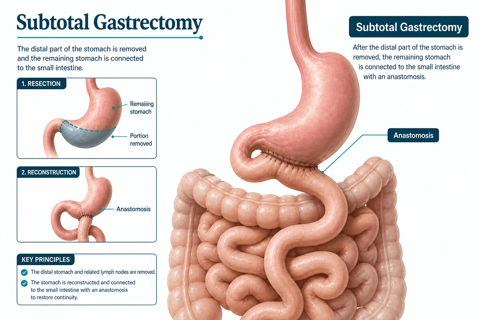 Subtotal gastrectomy — educational figure