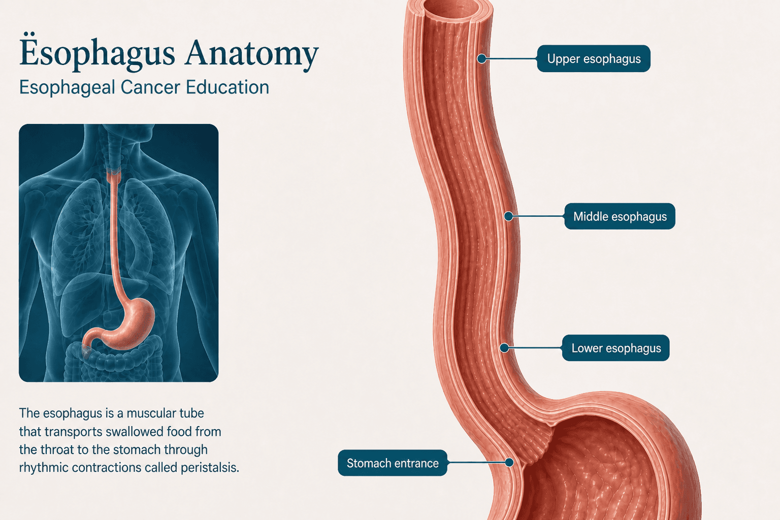 Esophageal Cancer — educational figure