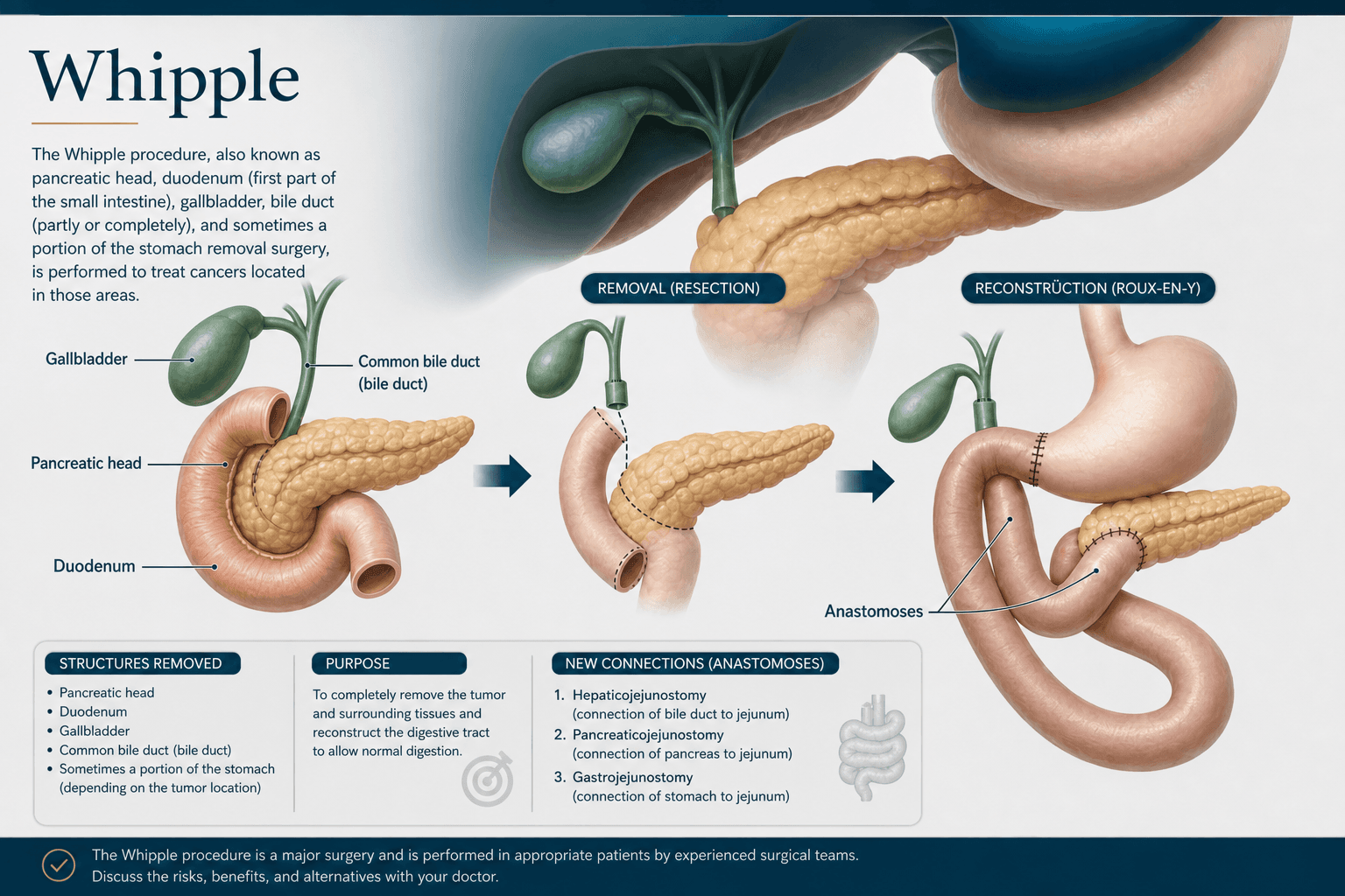 Whipple procedure — educational figure