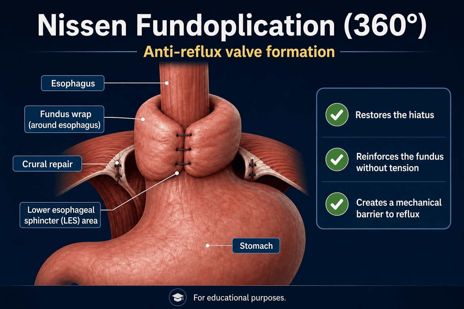 Nissen fundoplication — educational figure