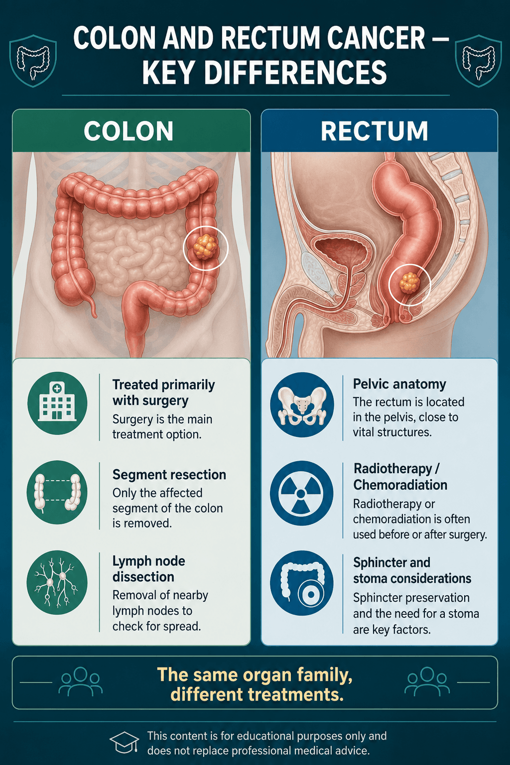 Rectal vs colon cancer differences — educational figure