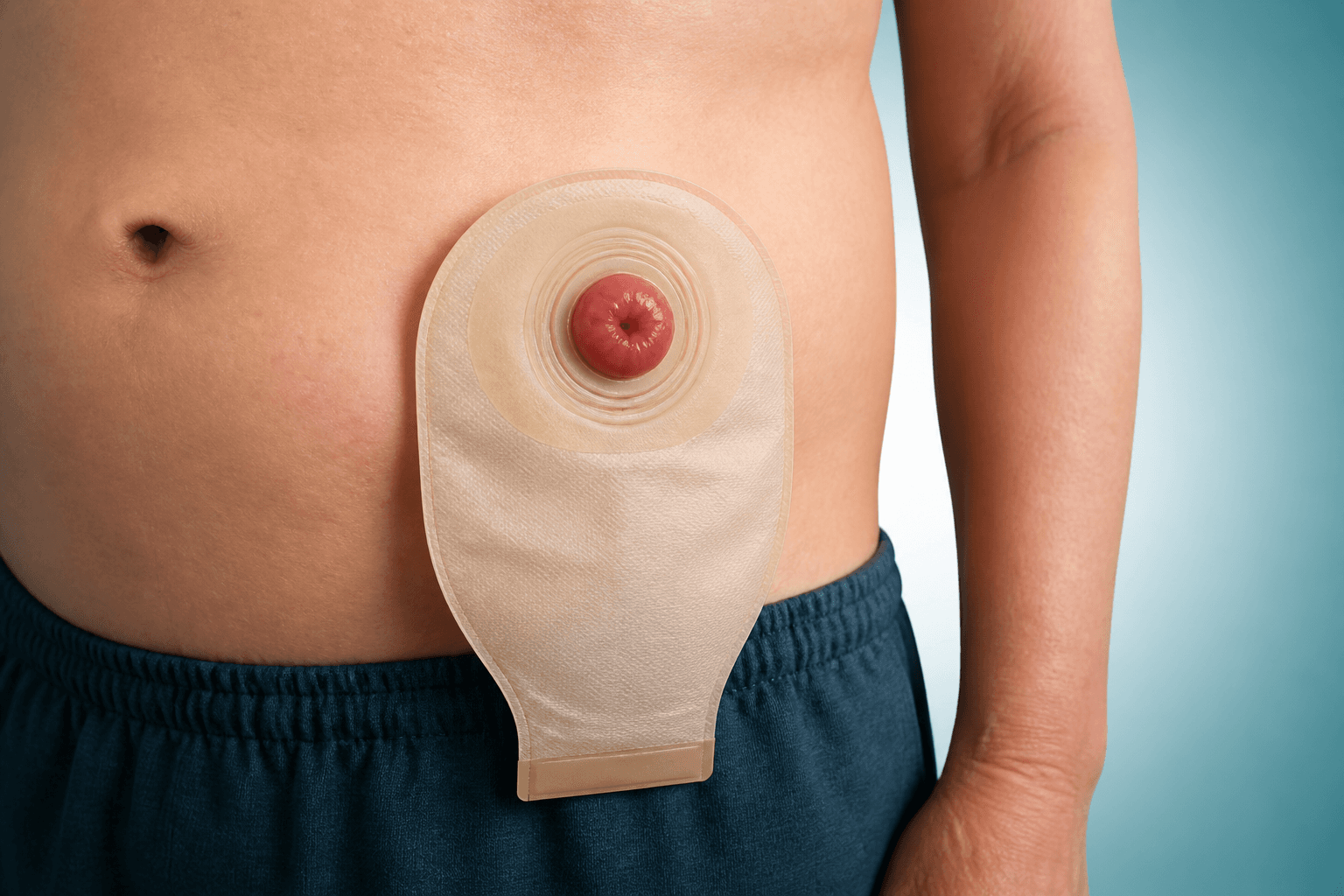 Stoma ve ostomi torbası 3D eğitim görseli
