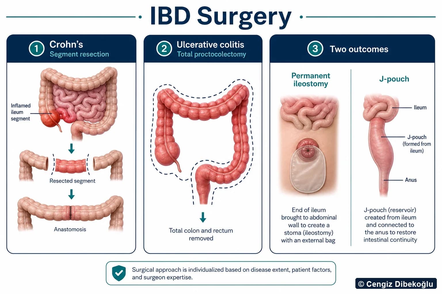 3D diagram: IBD surgery — Crohn's, UC, stoma and J-pouch options