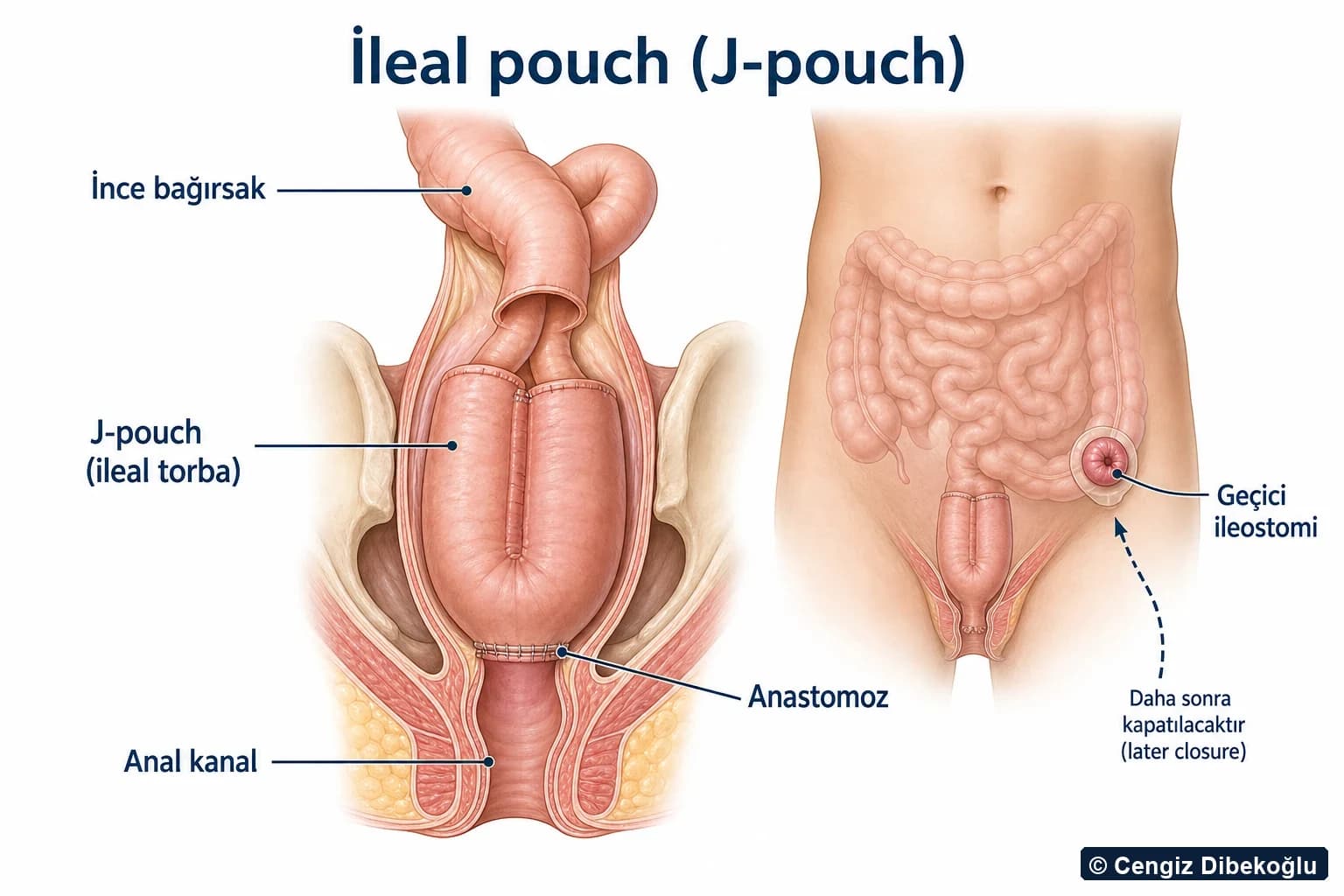 3D şema: ince bağırsaktan J-pouch, anal kanal anastomozu ve geçici ileostomi
