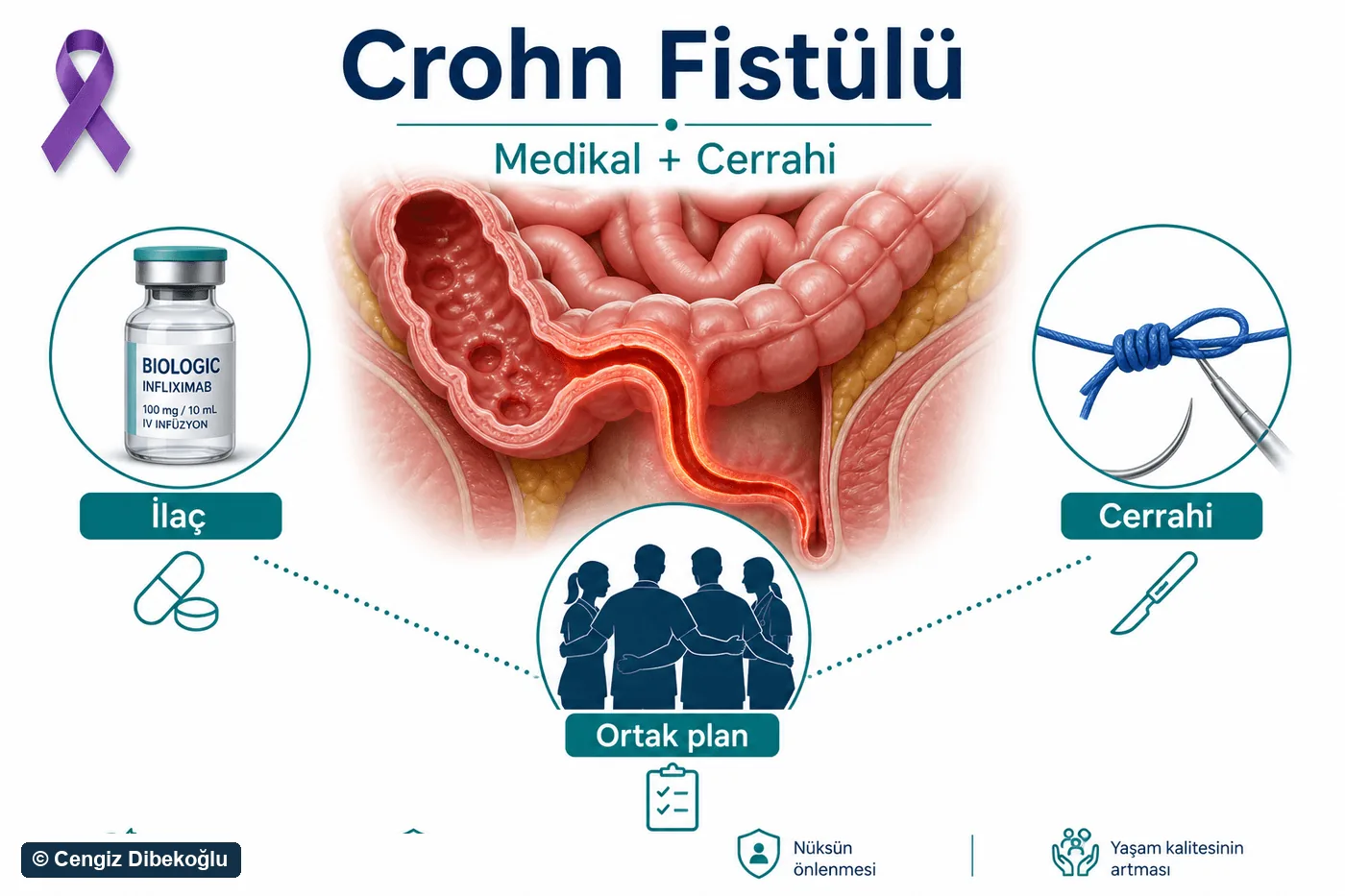 Crohn fistülü