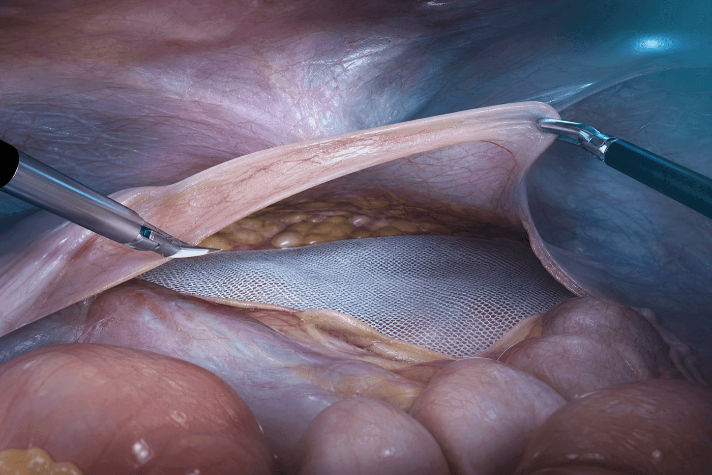 TAPP transabdominal preperitoneal onarımın 3D şematik görseli