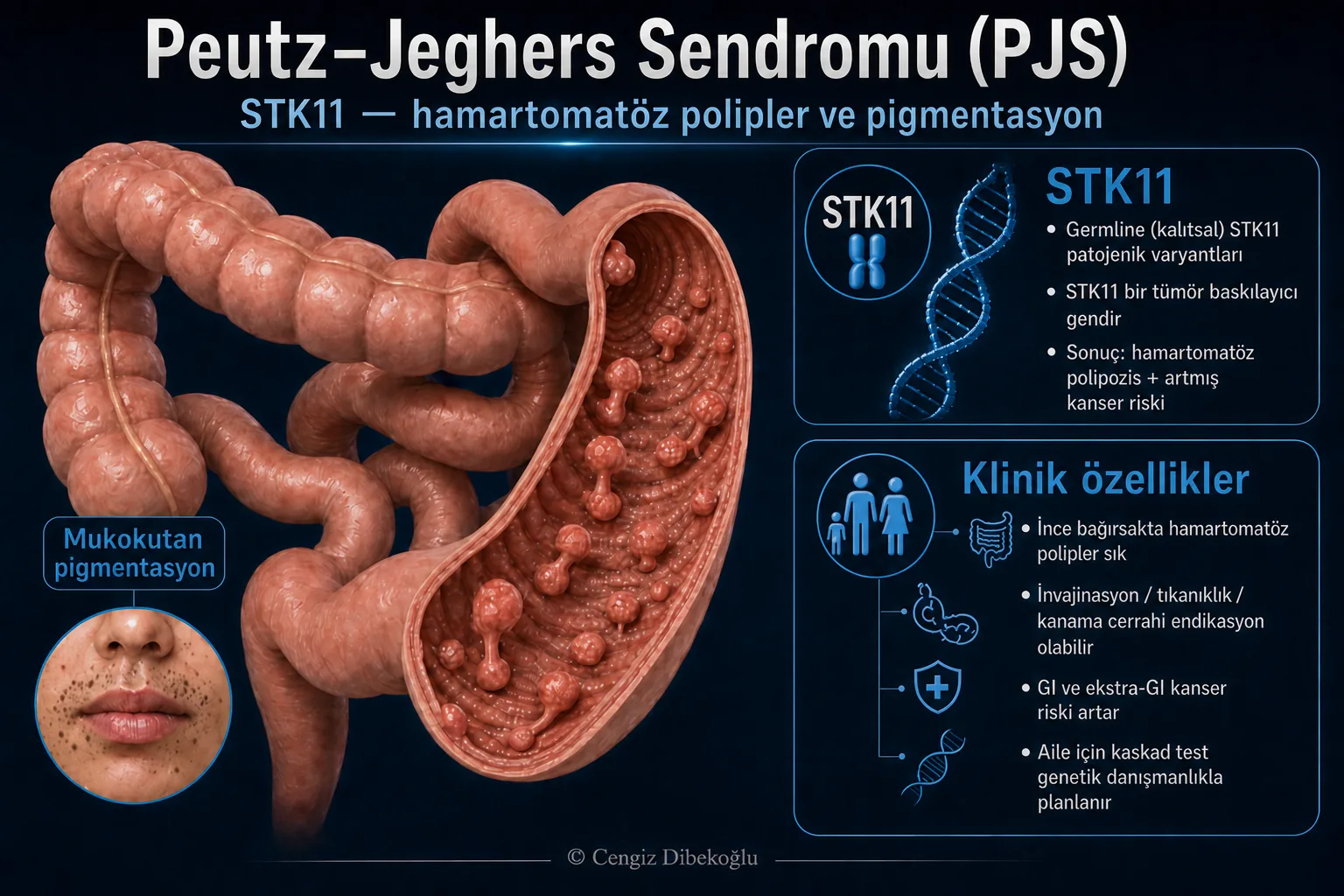 Peutz–Jeghers