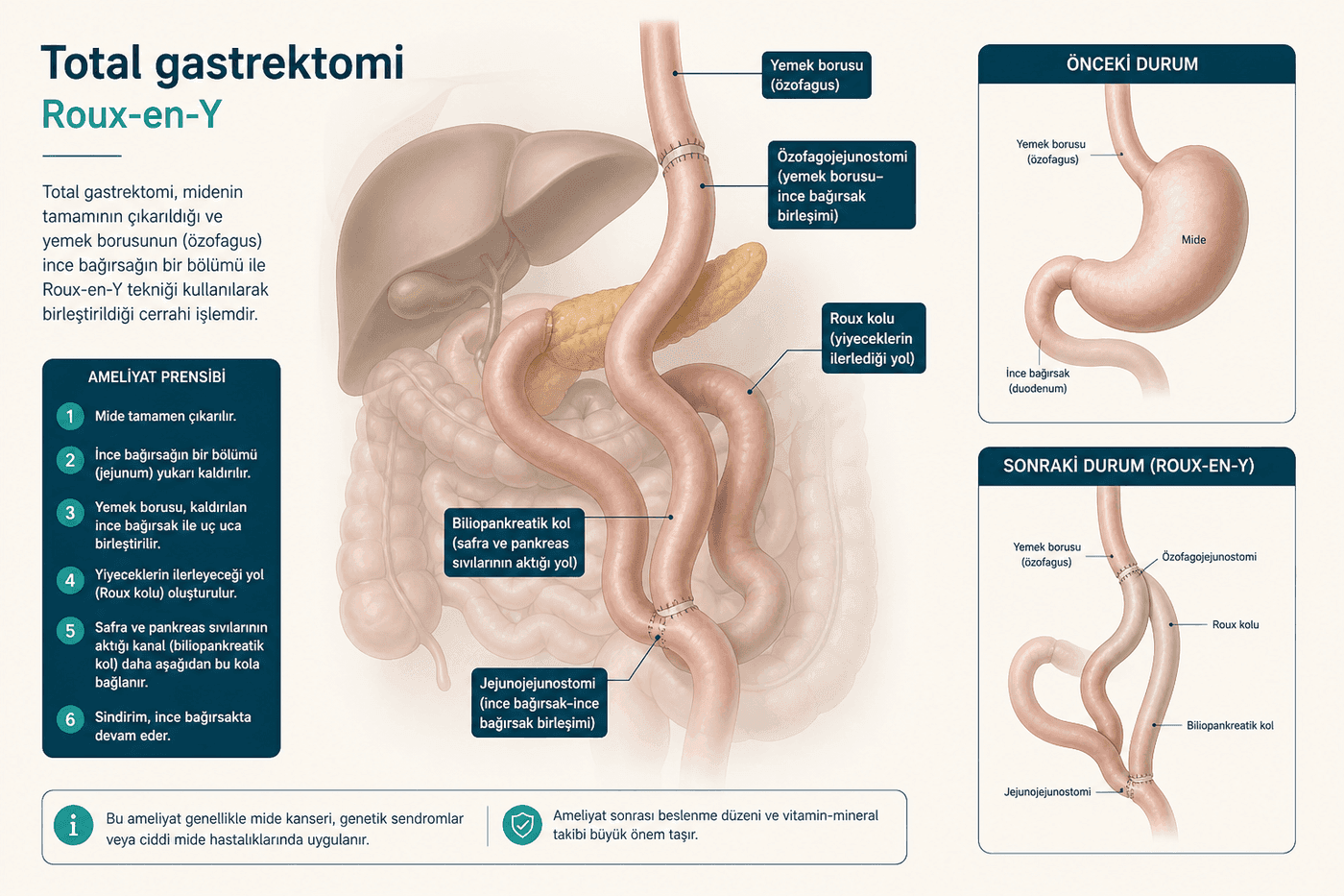 Total gastrektomi