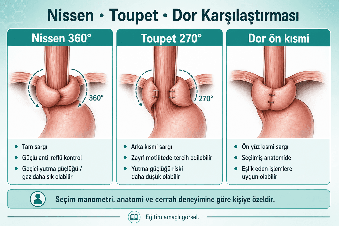 Nissen, Toupet ve Dor karşılaştırması Türkçe eğitim görseli