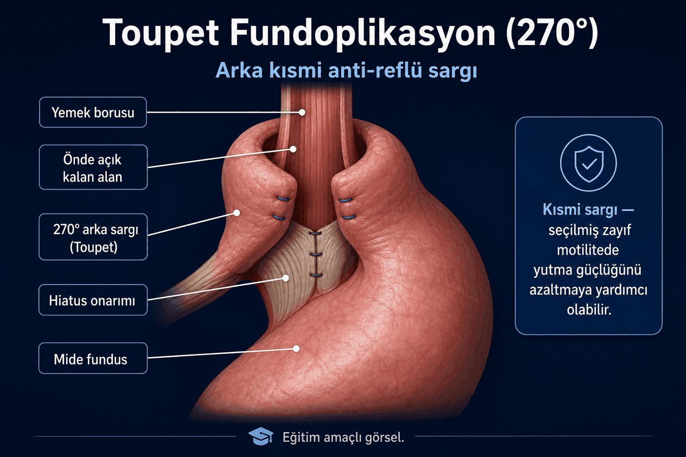 Toupet (270° arka kısmi)