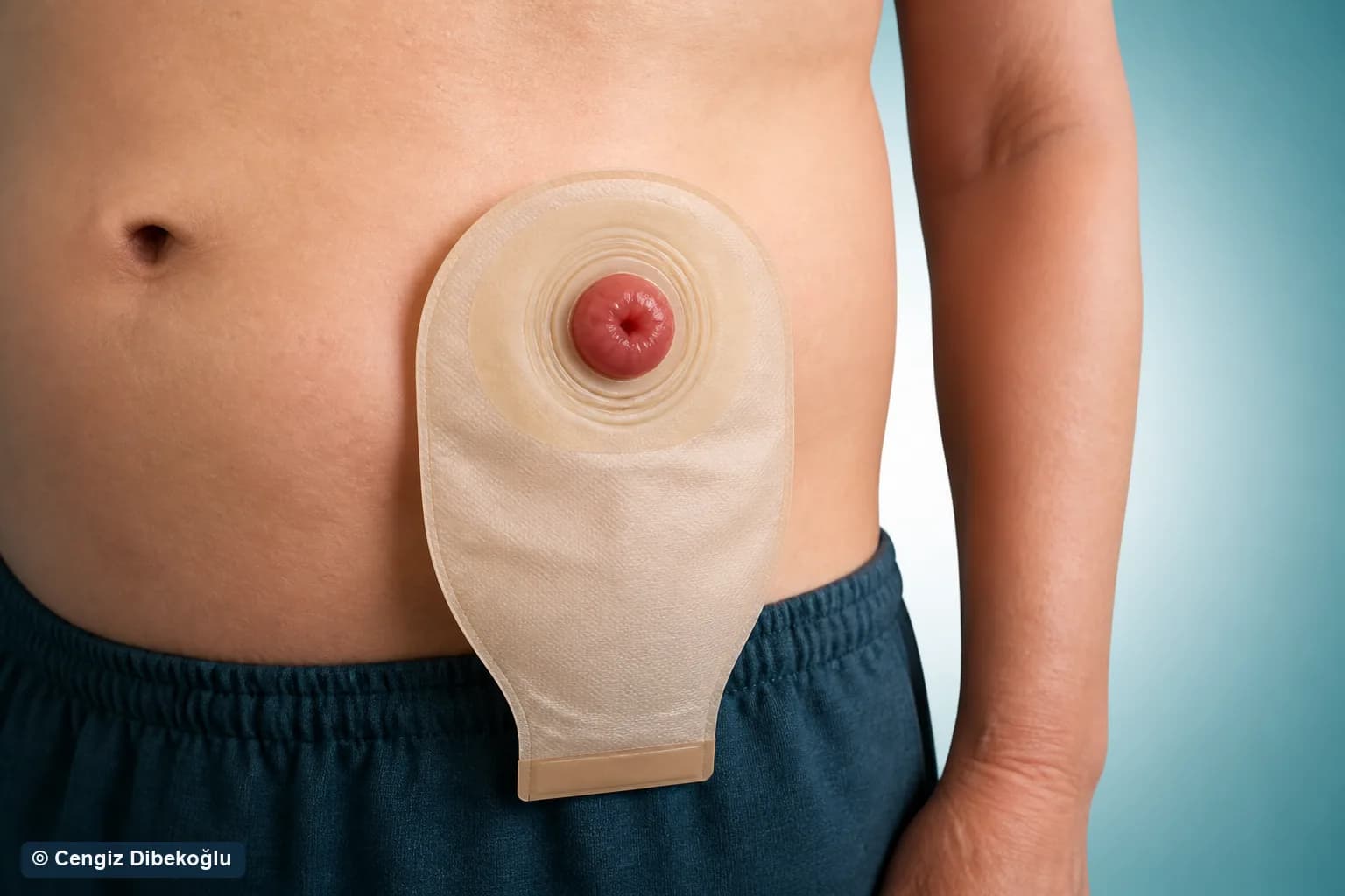 Stoma yaşam rehberi