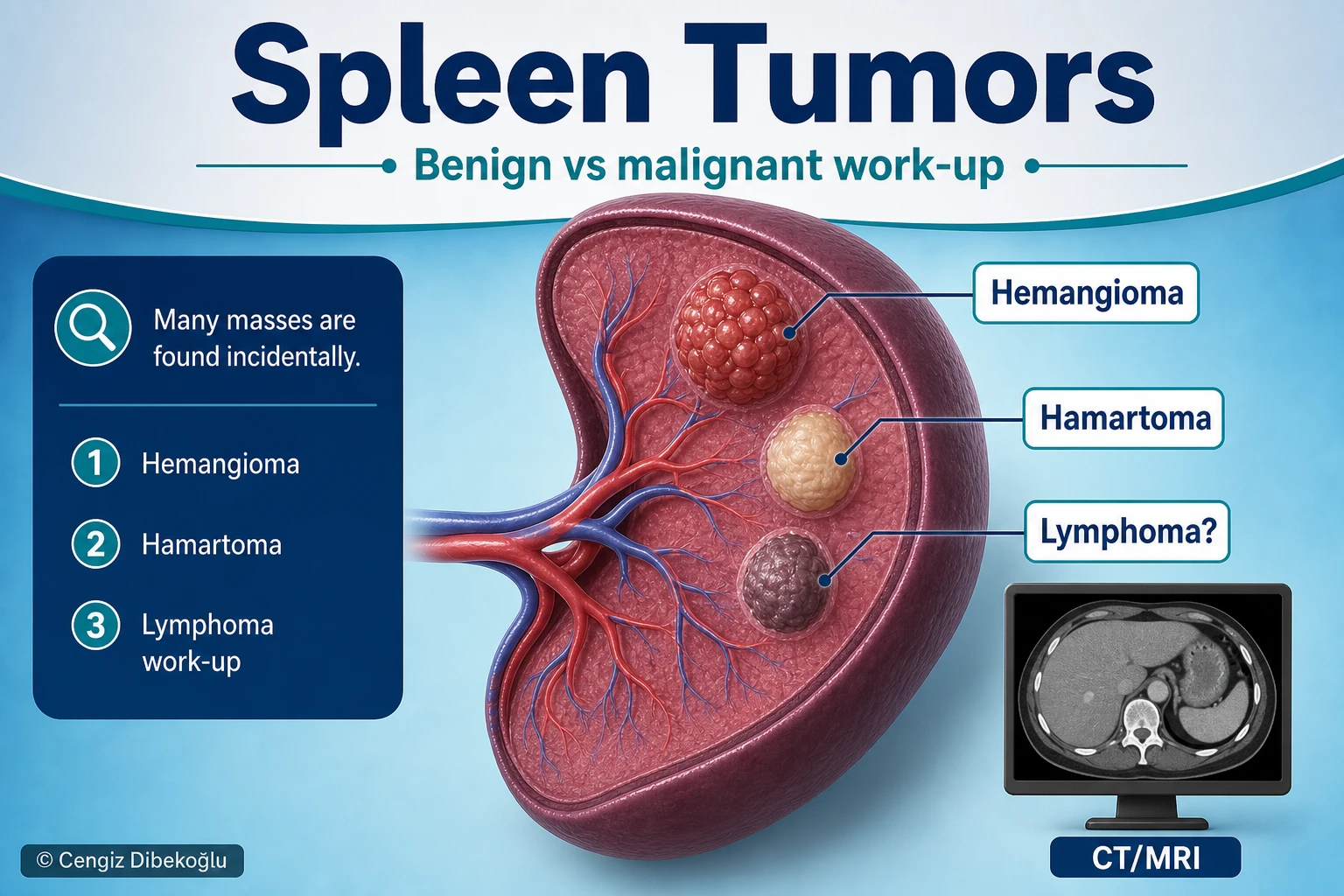 3D diagram: Spleen tumors