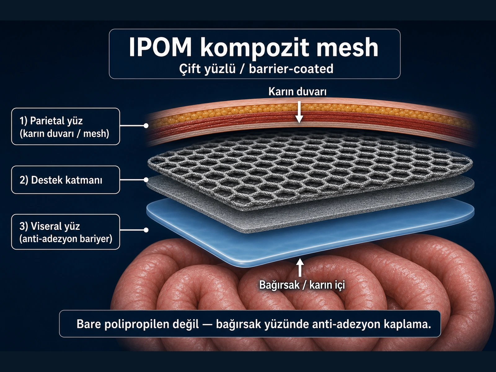 IPOM kompozit mesh kesiti: parietal yüz (karın duvarı), destek katmanı ve viseral anti-adezyon bariyer yüzü