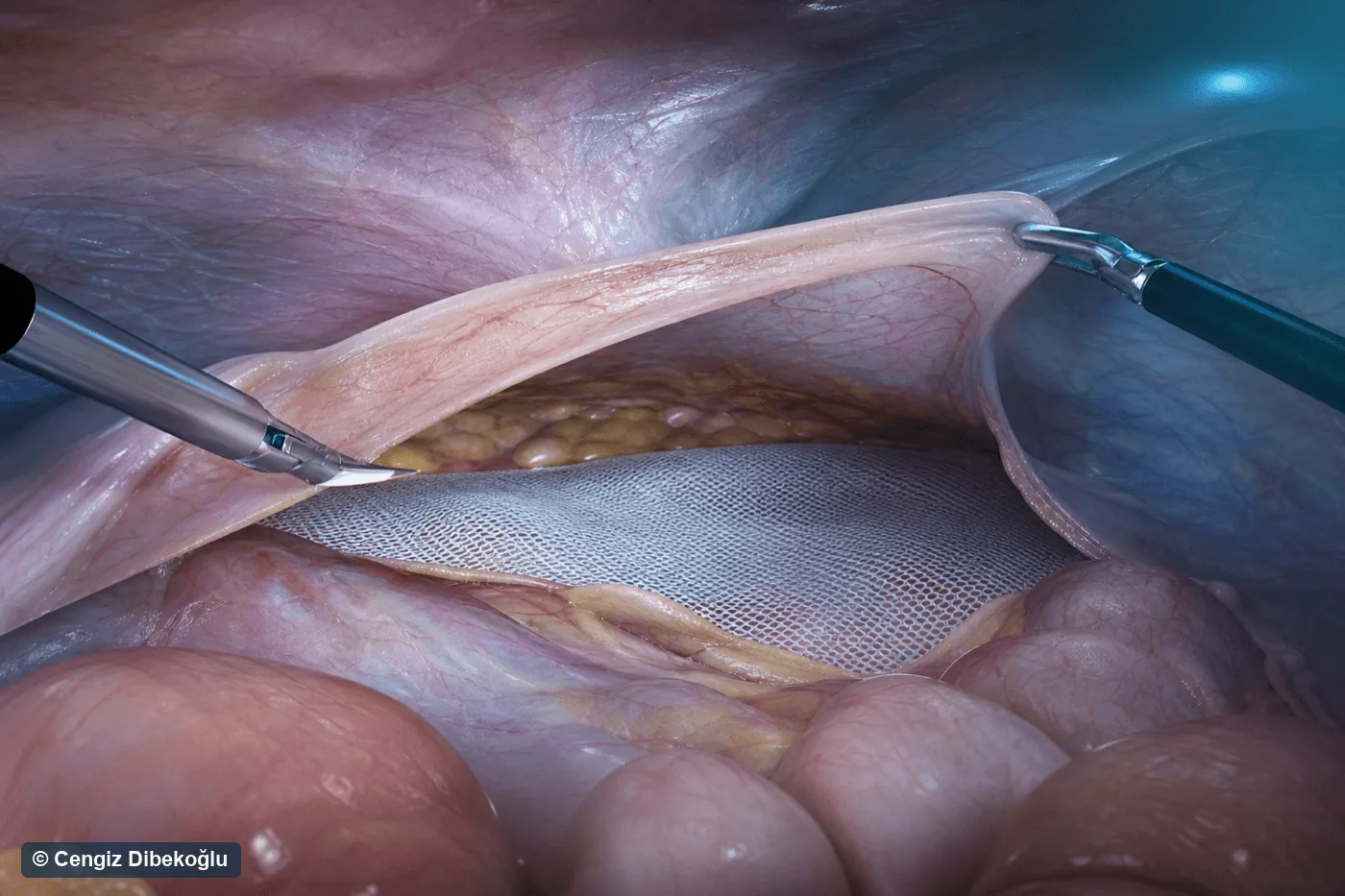 3D eğitim şeması: TAPP transabdominal preperitoneal onarımında periton flebinin açılması ve mesh yerleşimi