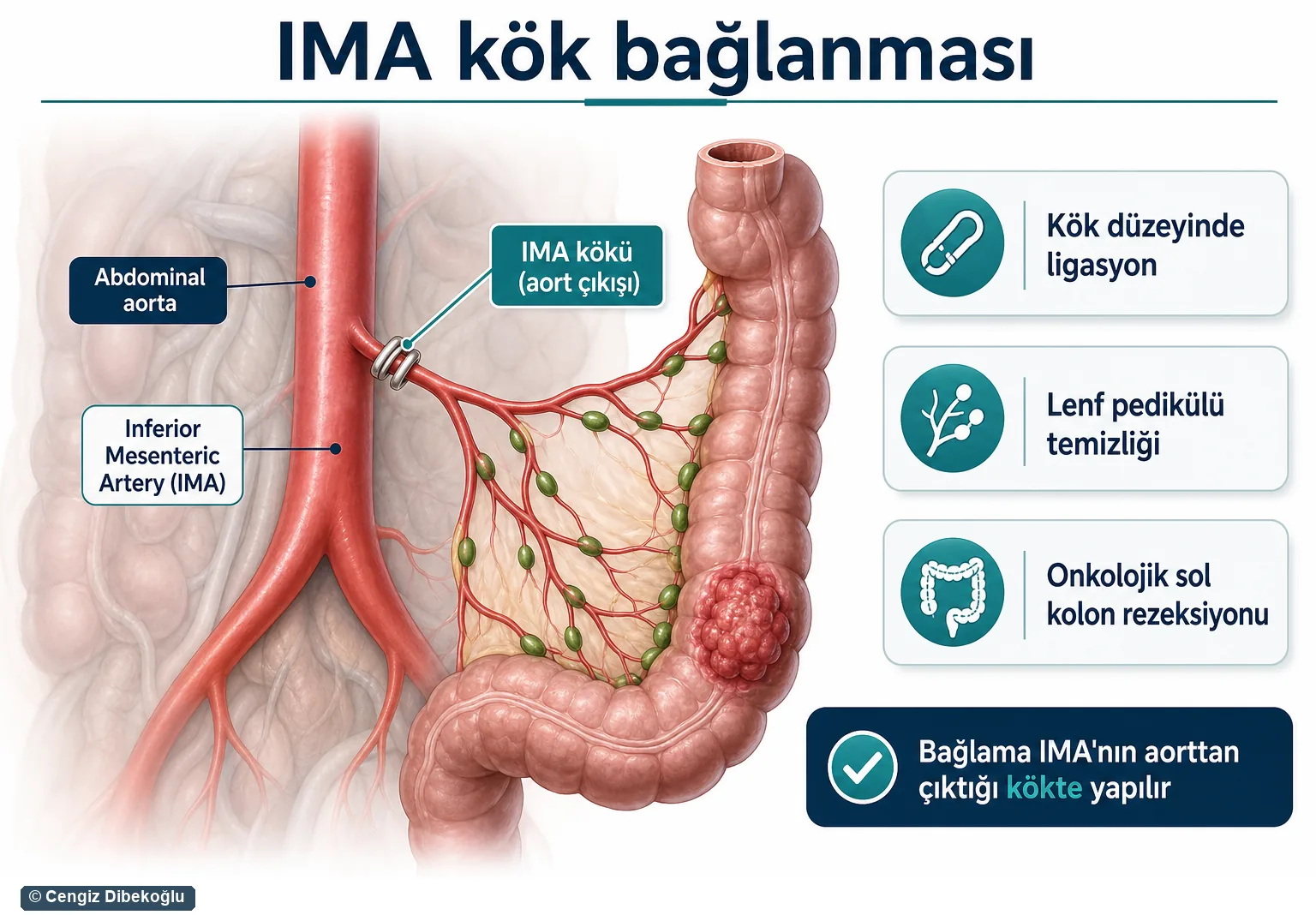 IMA kök bağlanması 3D — aort çıkışında ligasyon