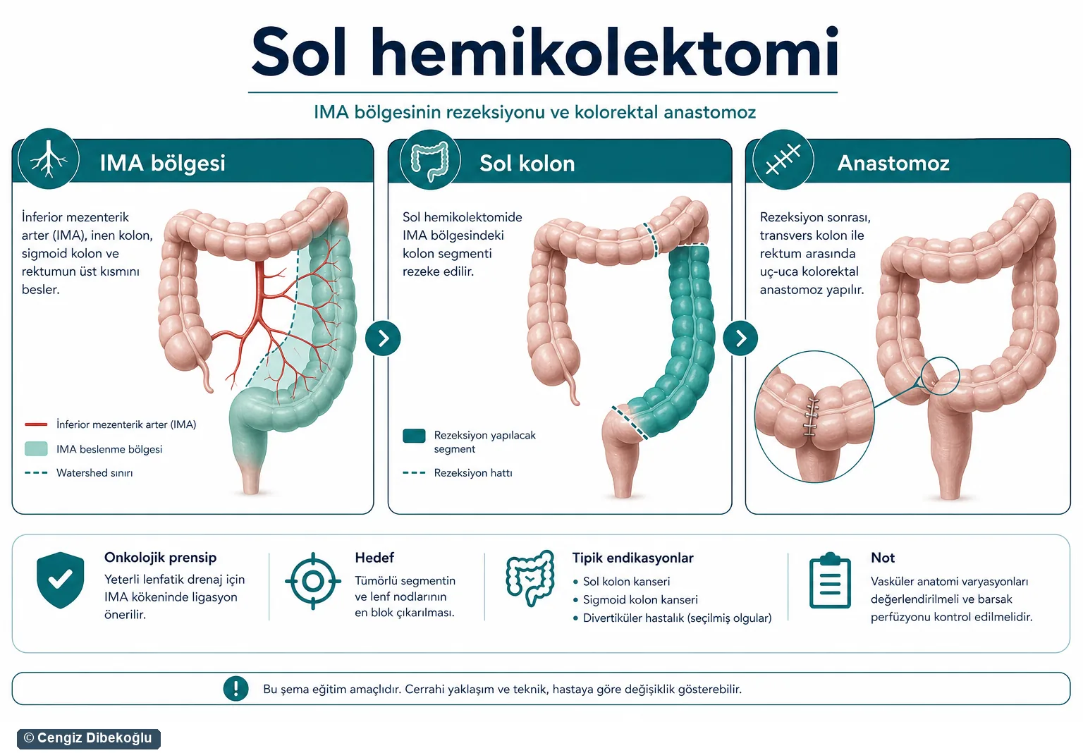 Sol hemikolektomi 3D