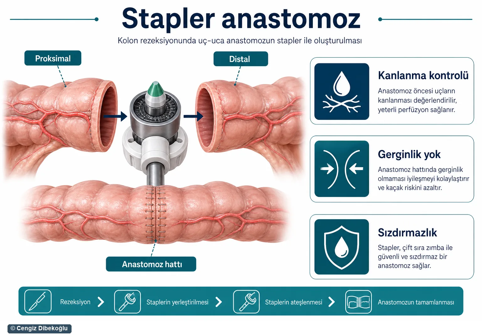 Stapler anastomoz 3D