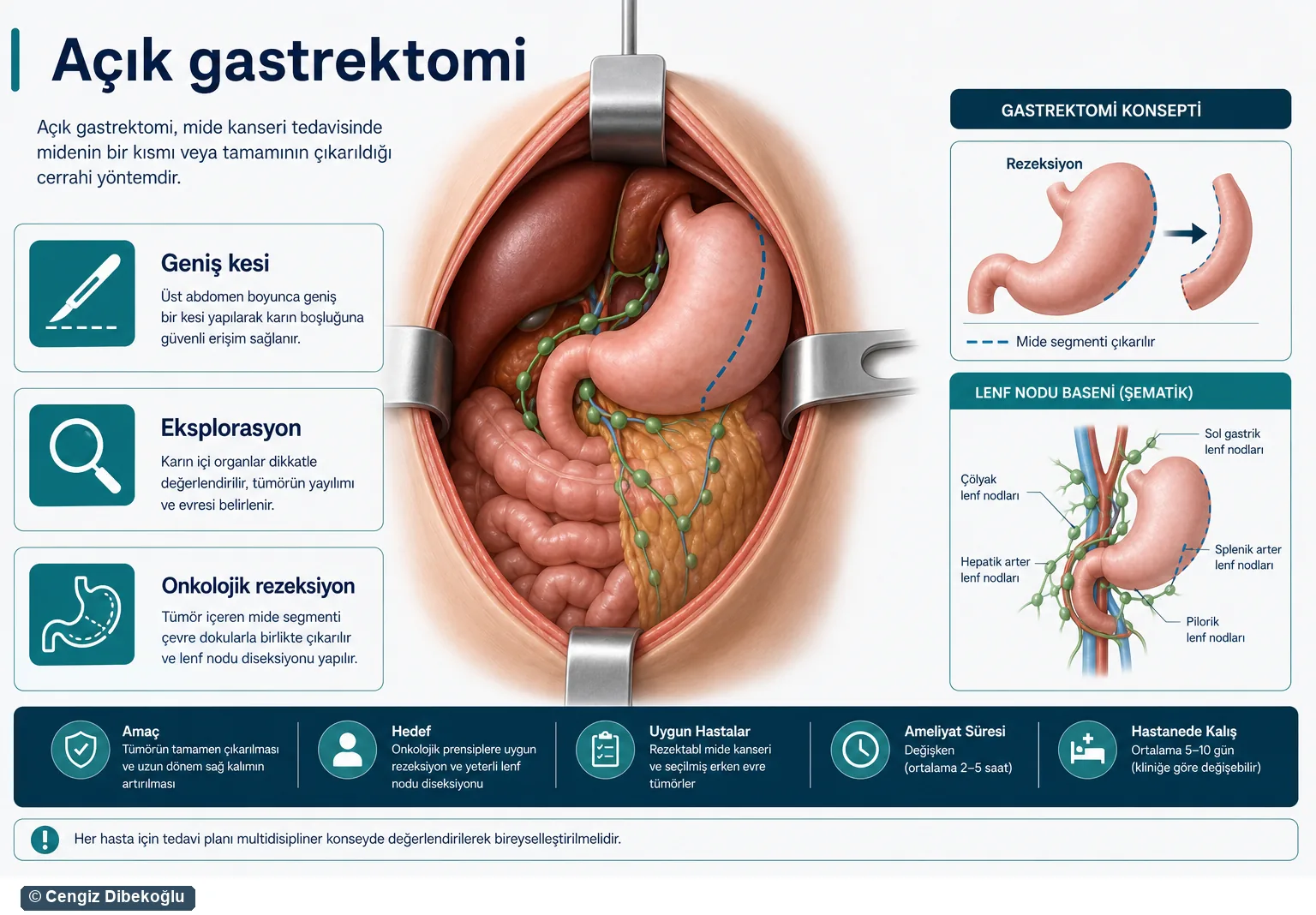 Açık gastrektomi 3D