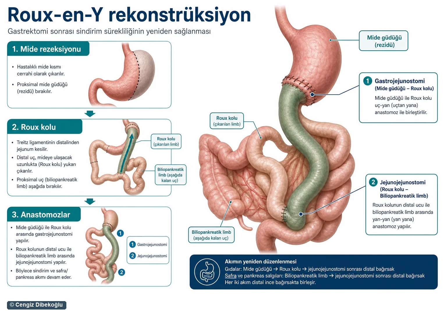 Roux-en-Y rekonstrüksiyon 3D