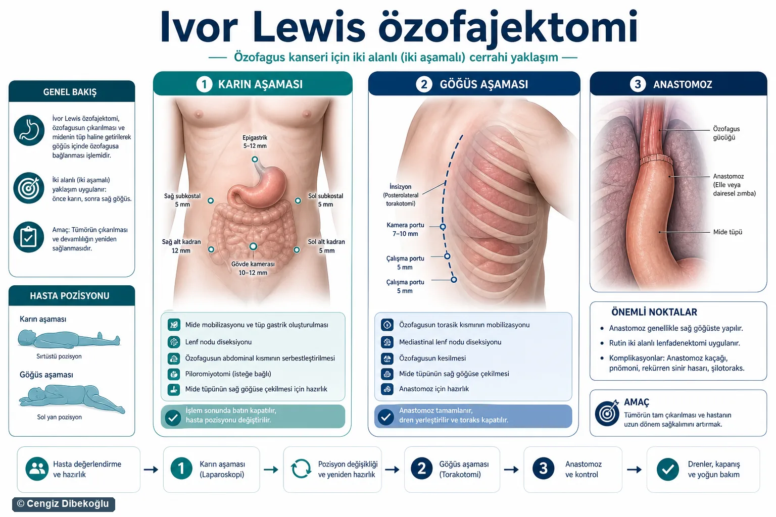 Ivor Lewis özofajektomi 3D