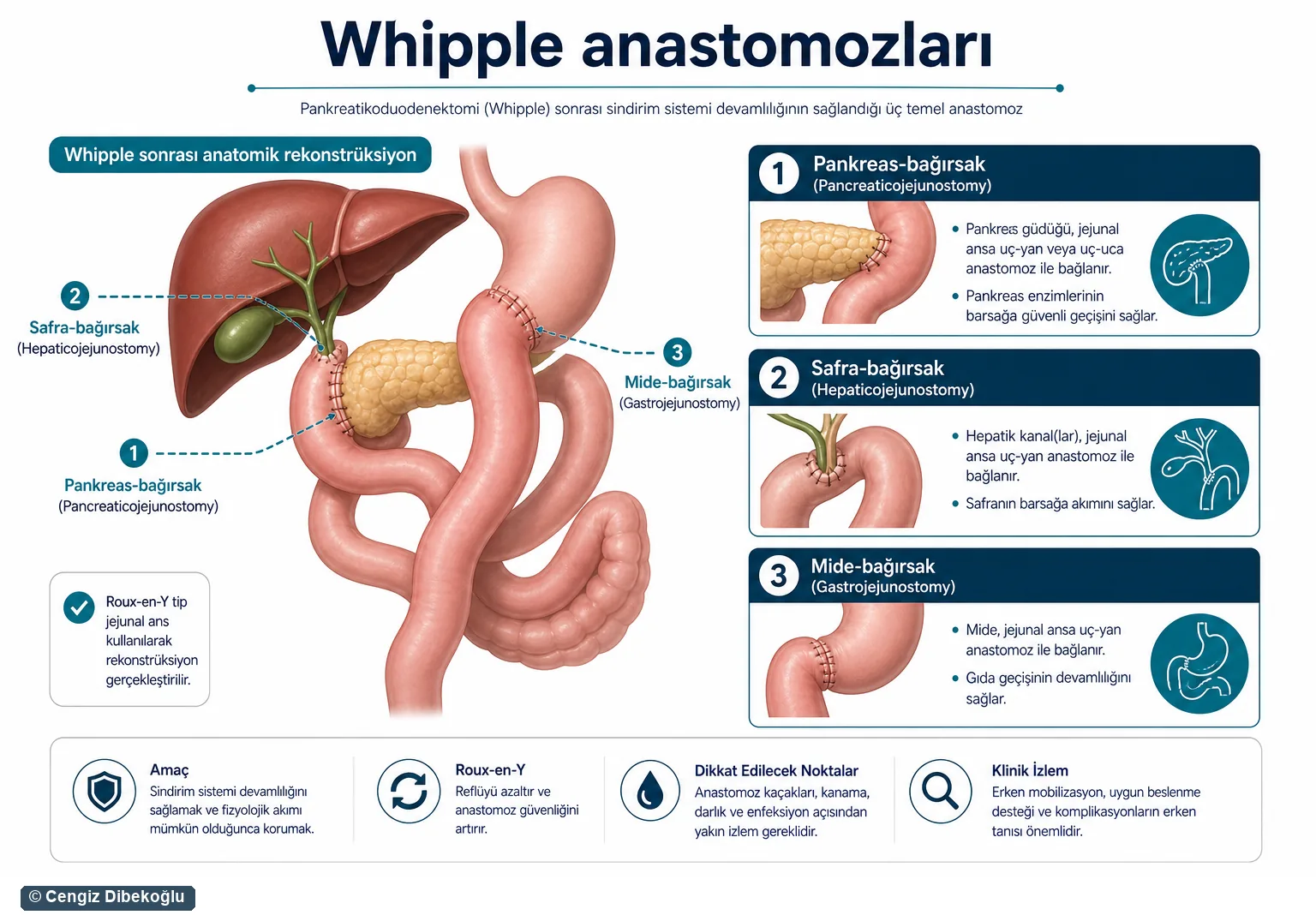 Whipple anastomozları 3D