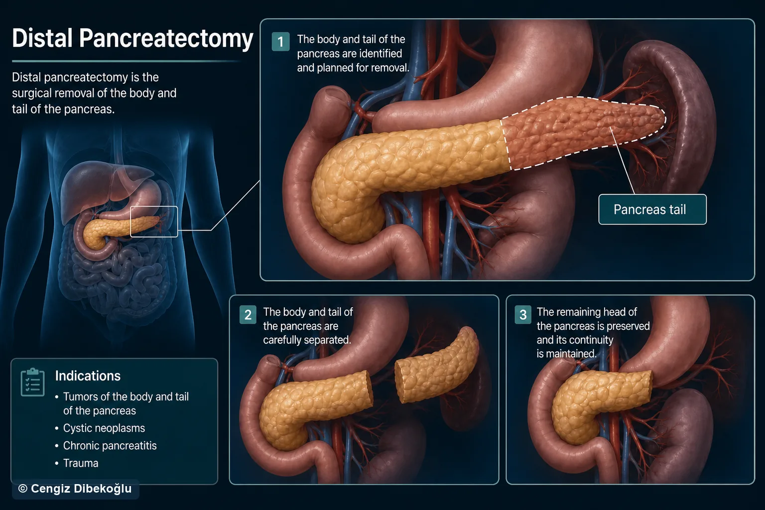 3D diagram: Distal pancreatectomy — distal pancreatectomy