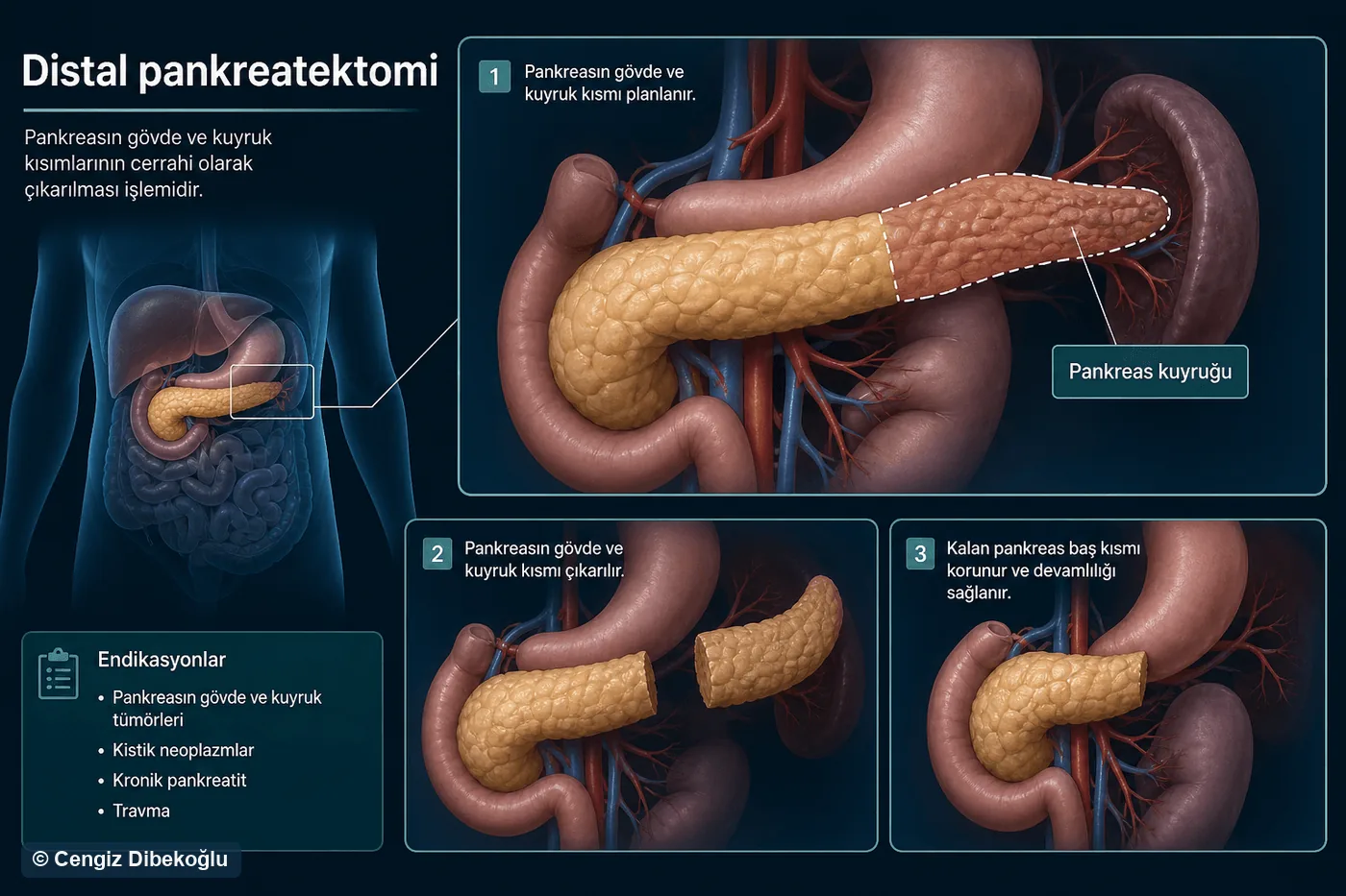 Distal pankreatektomi