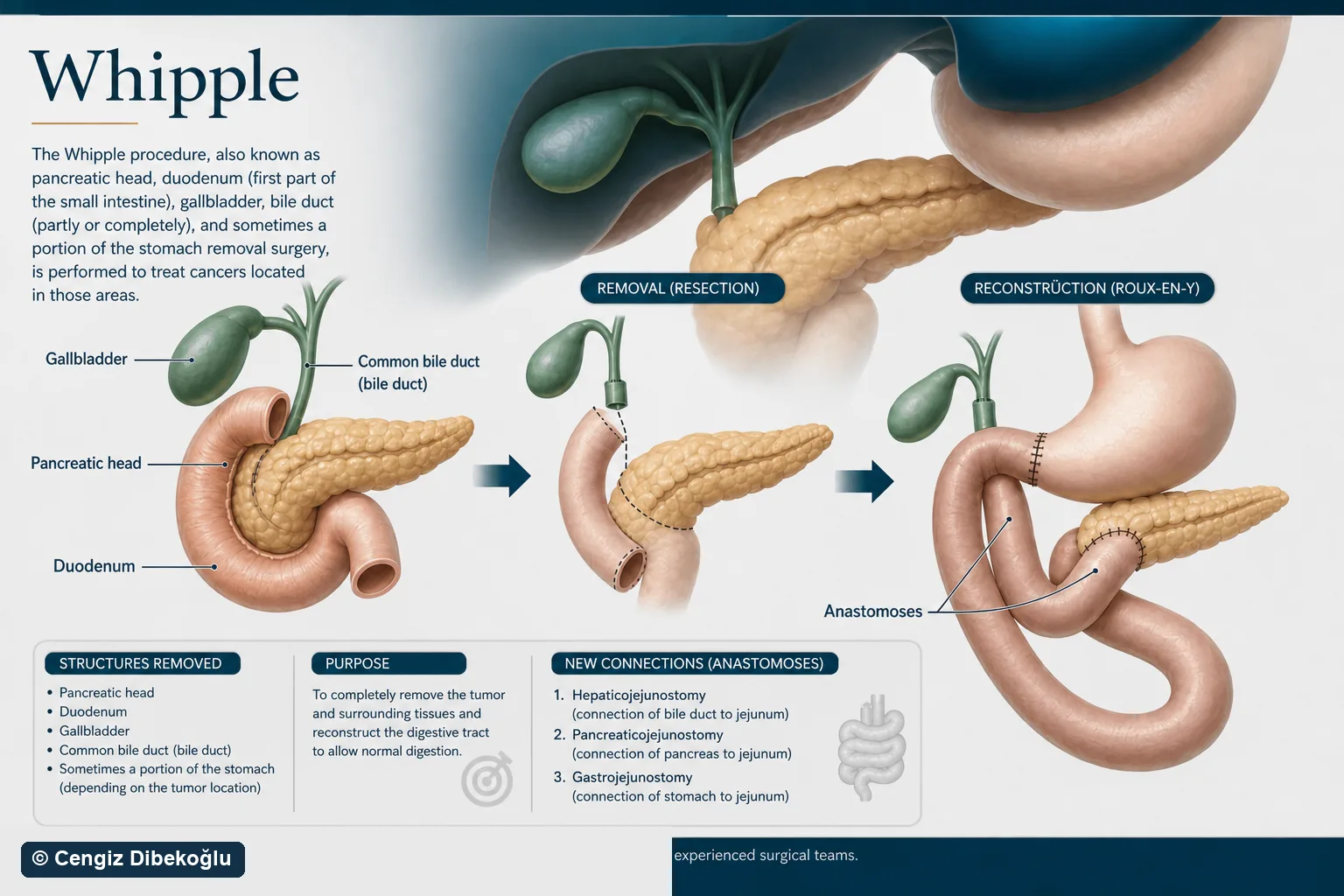3D diagram: Whipple — whipple procedure
