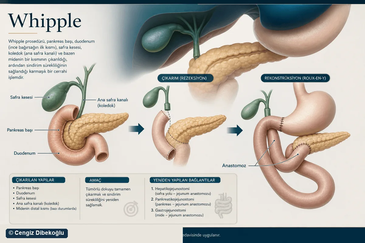 Whipple