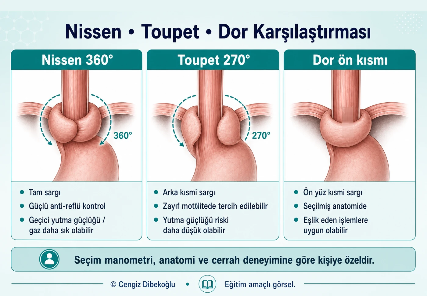 3D eğitim şeması: Nissen, Toupet ve Dor fundoplikasyon karşılaştırması