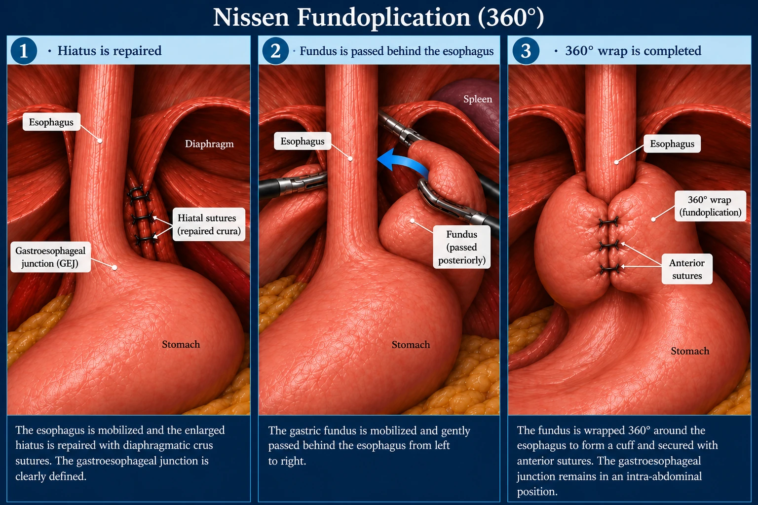 3D diagram: Antireflux surgery — nissen fundoplication